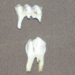 This photo shows the difference between the three-cusp temporary third premolar (top) and the permanent third premolar with two cusps (bottom).